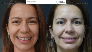 ba_af_sbr_fat_transfer_botox