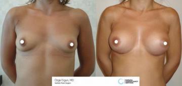 Breast_aug_Oe_21