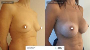 Breast_aug_Oe_22_2