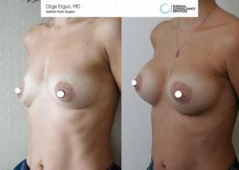 Breast_aug_Oe_3_3