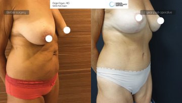 ba_af_mrs_breastlift_tummytuck4