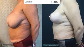 be_af_abl_tummytuck_breastlift_2