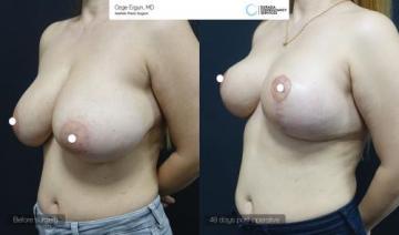 be_af_zln_breast_lift3