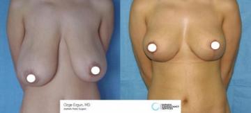 breast_lift