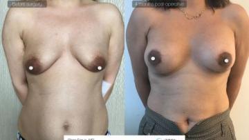 Breast_aug_Oe_10_2