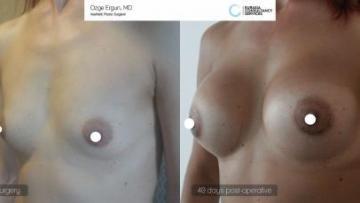 Breast_aug_Oe_17_1