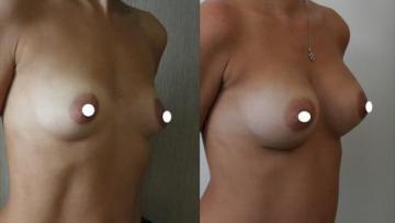 Breast_aug_Oe_3_2