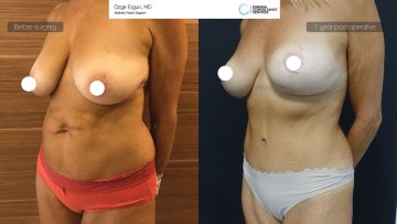 ba_af_mrs_breastlift_tummytuck5