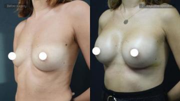 ba_af_sbr_breast_augmentation2