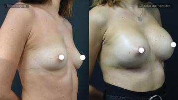 ba_af_sbr_breast_augmentation3