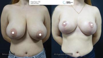 be_af_zln_breast_lift1