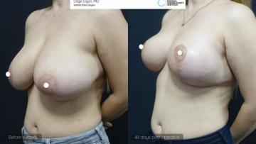 be_af_zln_breast_lift3