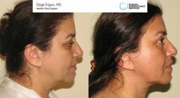 Face_Lift_OE_2_2