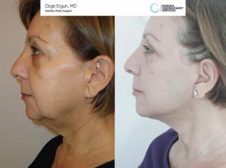 Face_Lift_OE_6_2