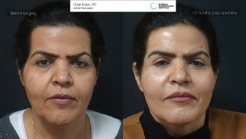 ba_af_ash_facelift1