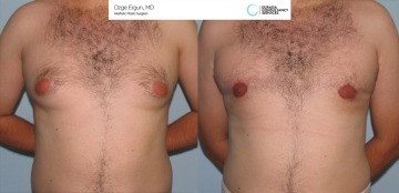 Gynecomastia_OE_1_2