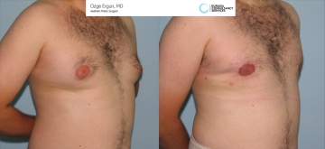 Gynecomastia_OE_1_3