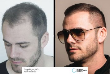 Hair_Transplant_OE_29_1