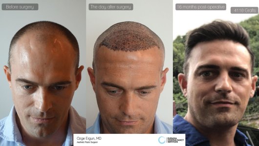 Hair Transplant