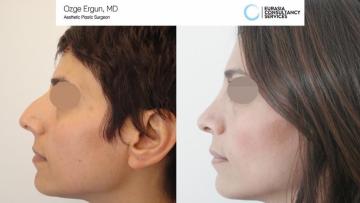 rhinoplasty