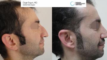 rhinoplasty