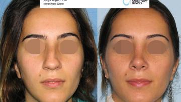 rhinoplasty