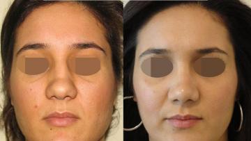 rhinoplasty