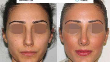 rhinoplasty