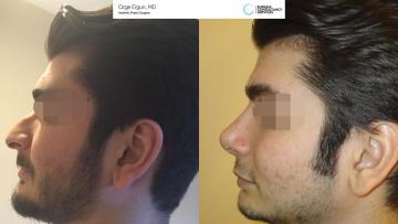 rhinoplasty