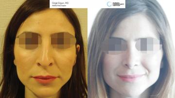 rhinoplasty