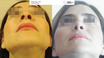 rhinoplasty