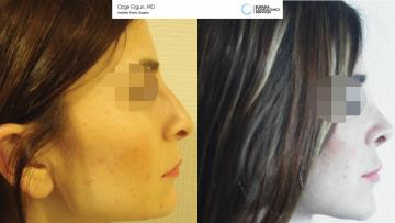 rhinoplasty