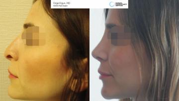 rhinoplasty