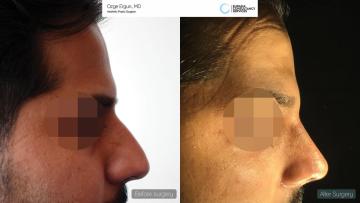 rhinoplasty