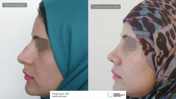 rhinoplasty