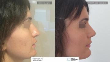 rhinoplasty