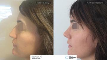 rhinoplasty