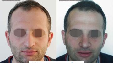 rhinoplasty