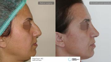 rhinoplasty