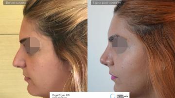 rhinoplasty