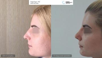 rhinoplasty