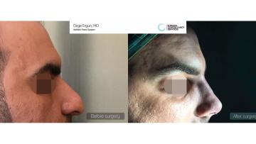 rhinoplasty