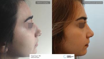 rhinoplasty