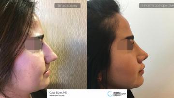 rhinoplasty