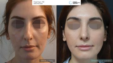 rhinoplasty