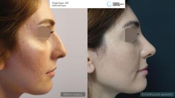 rhinoplasty