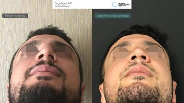 rhinoplasty