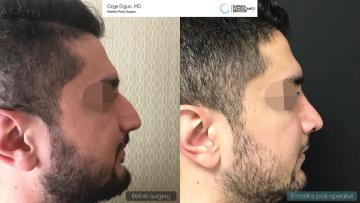 rhinoplasty