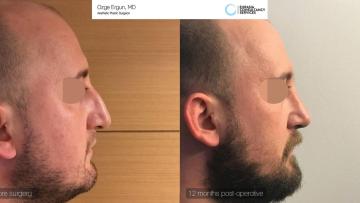 rhinoplasty