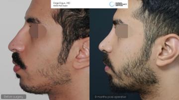 rhinoplasty